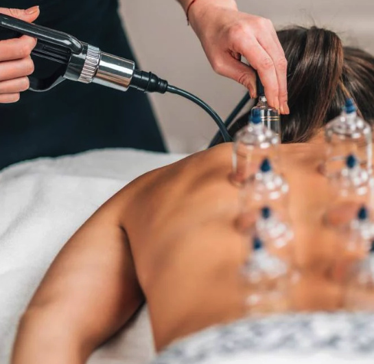Terapia de ventosas en la espalda